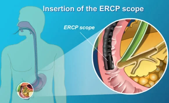 ERCP Aurangabad | Gandhi Hospital: Expert Diagnosis & Treatment of ...